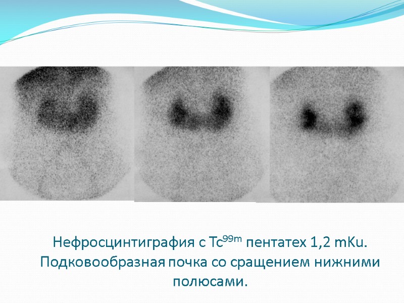 Нефросцинтиграфия с Tc99m пентатех 1,2 mKu.  Подковообразная почка со сращением нижними полюсами.